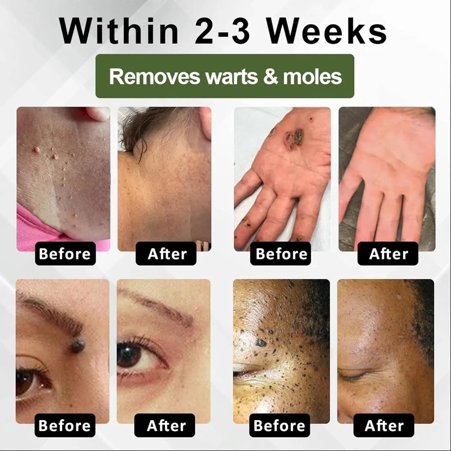 Natureerase 45g tube of hydrating mole removal gel for face and body treatment