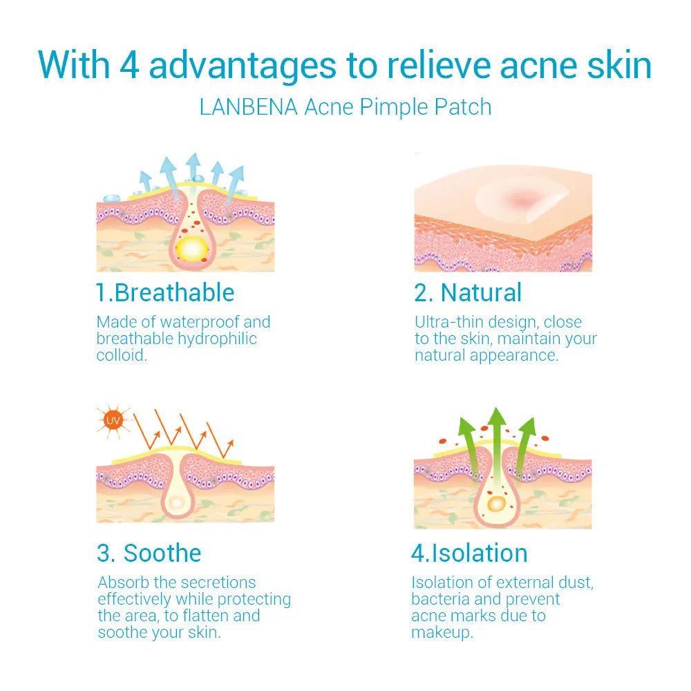 Acne stickers with tea tree oil and Calendula oil for treating blemishes and fading acne marks on scar-prone skin