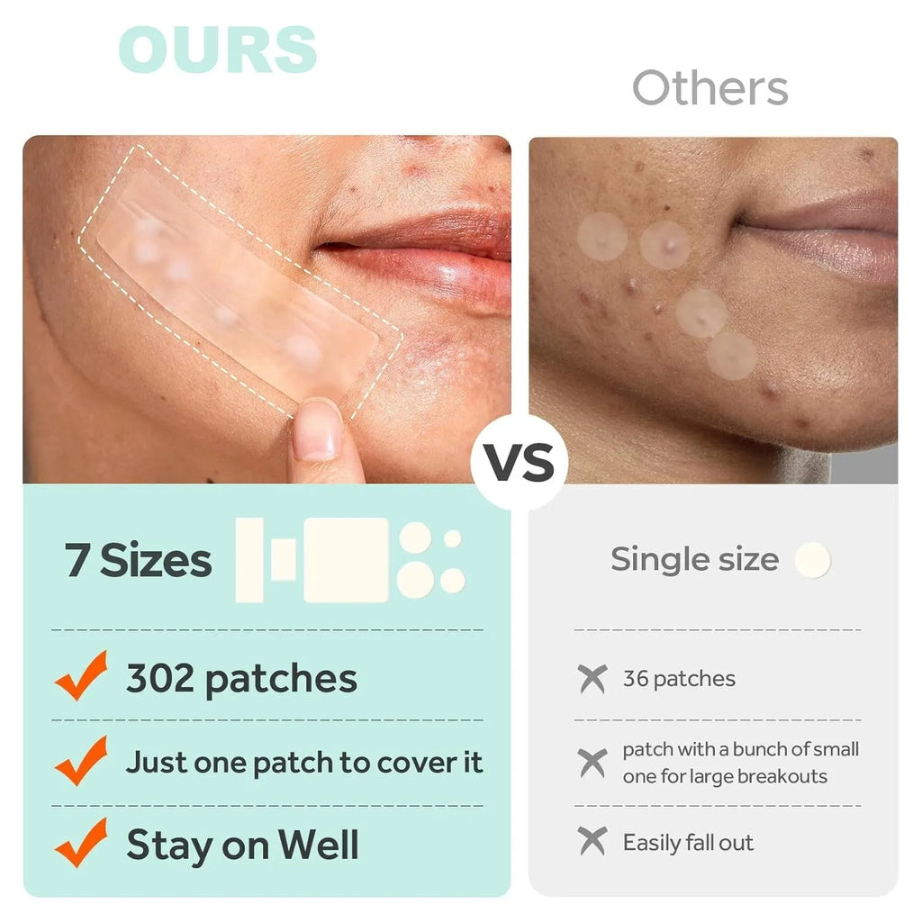 Acne cover patch mild desalting plastic plaster for pimple and closed mouth blemishes, 302 patches per box
