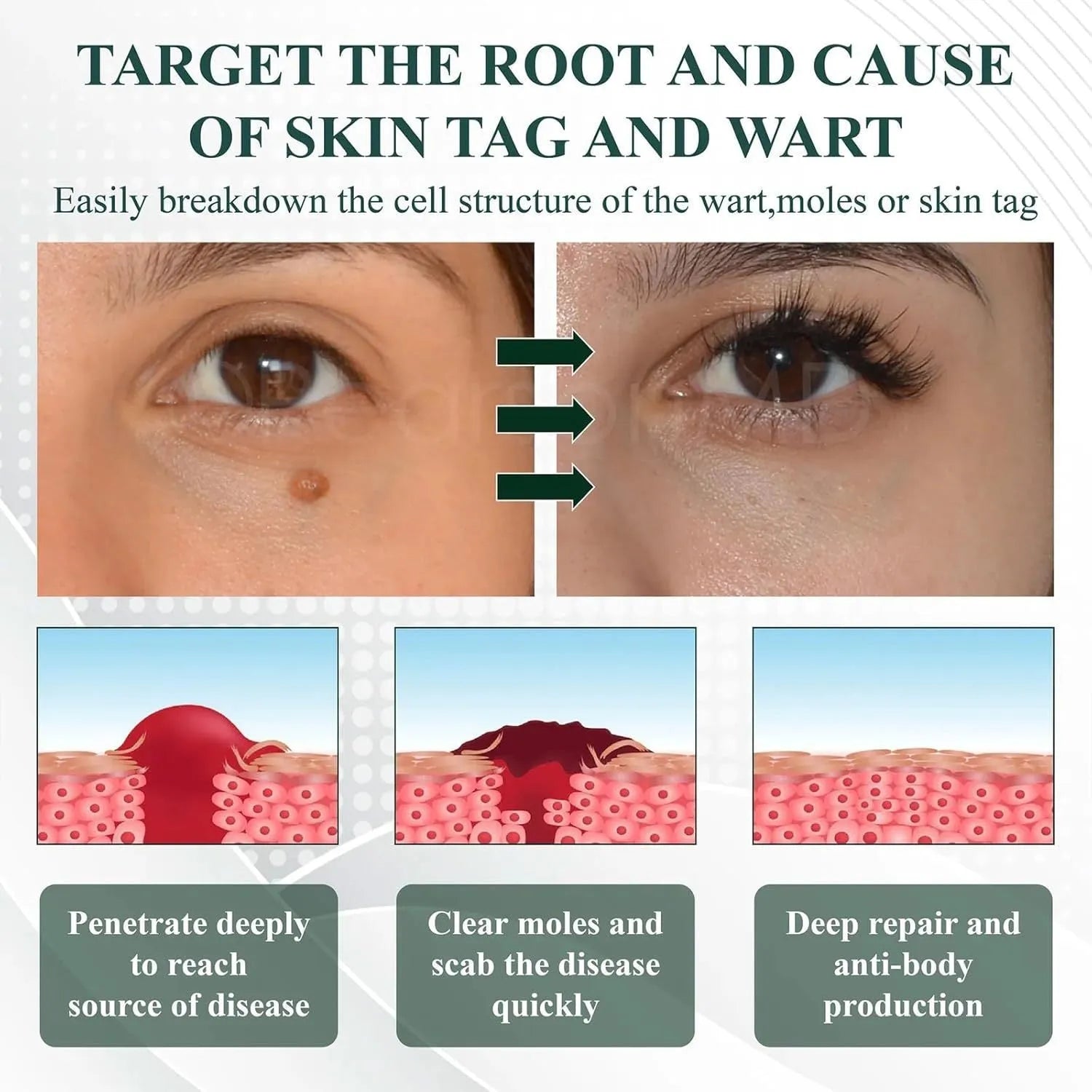 Natureerase 45g tube of hydrating mole removal gel for face and body treatment