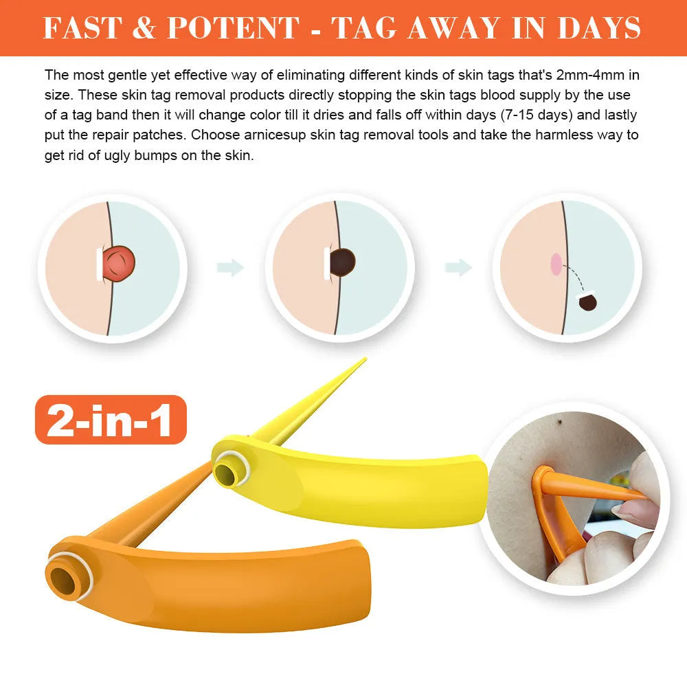 Orange-yellow mole remover tool set with two devices, rubber rings, cones, alcohol swabs, and repair sticker