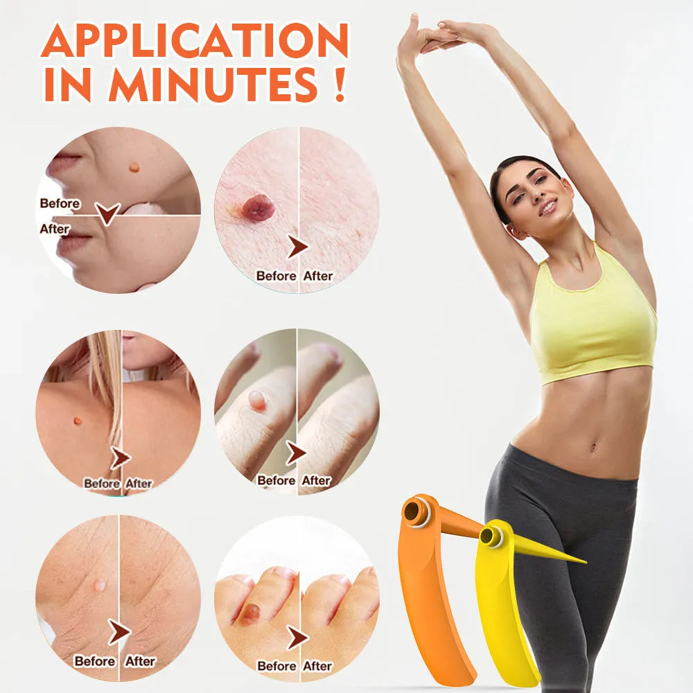 Orange-yellow mole remover tool set with two devices, rubber rings, cones, alcohol swabs, and repair sticker