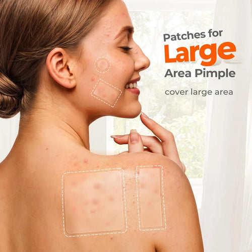 Acne cover patch mild desalting plastic plaster for pimple and closed mouth blemishes, 302 patches per box