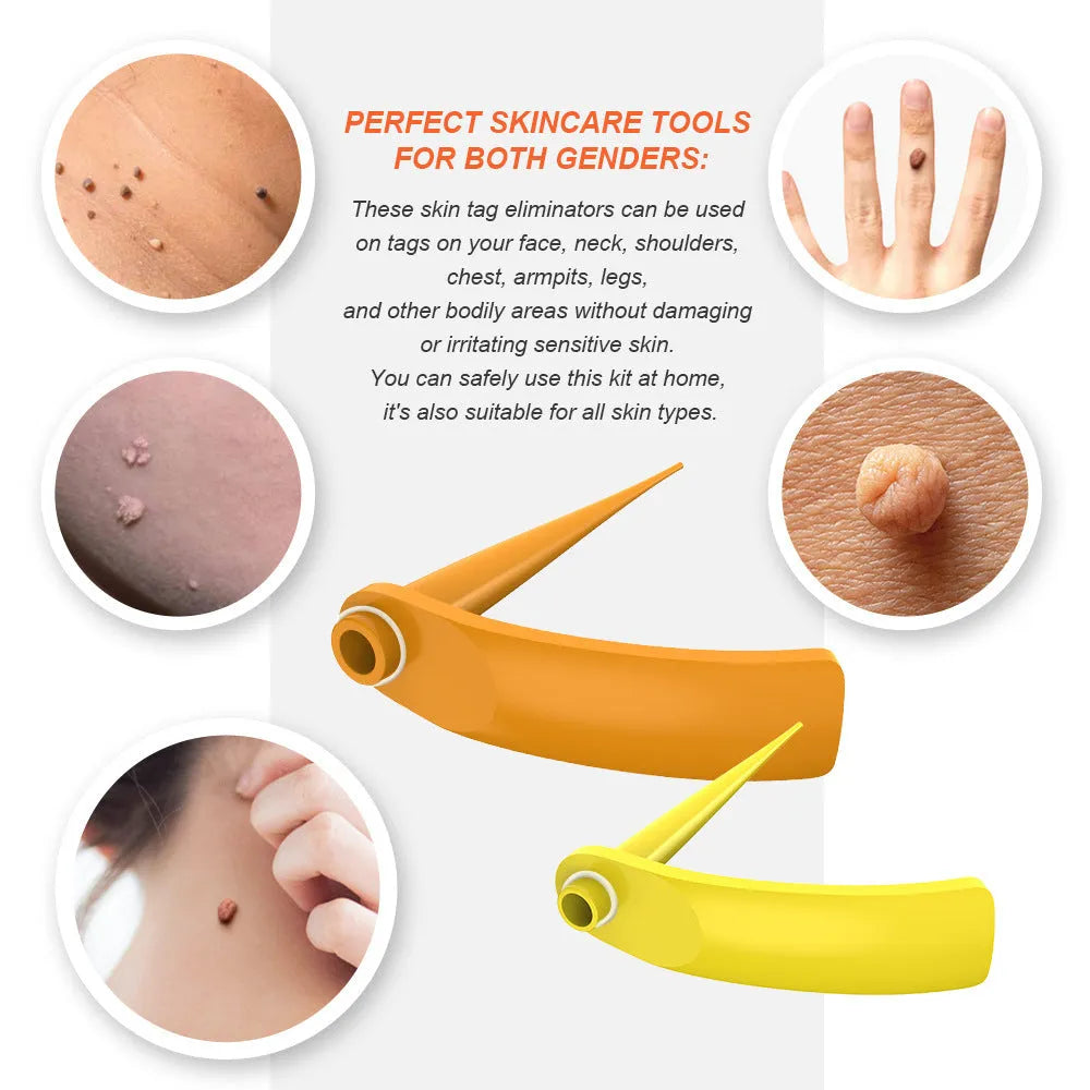 Orange-yellow mole remover tool set with two devices, rubber rings, cones, alcohol swabs, and repair sticker