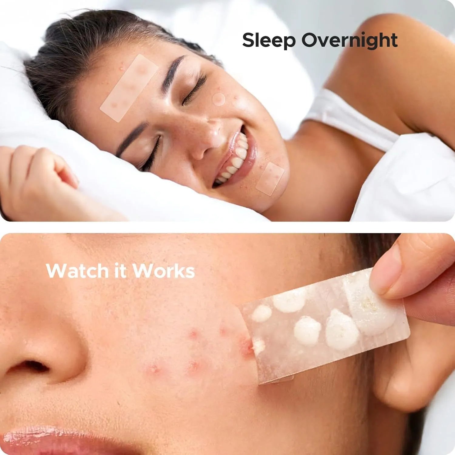 Acne cover patch mild desalting plastic plaster for pimple and closed mouth blemishes, 302 patches per box